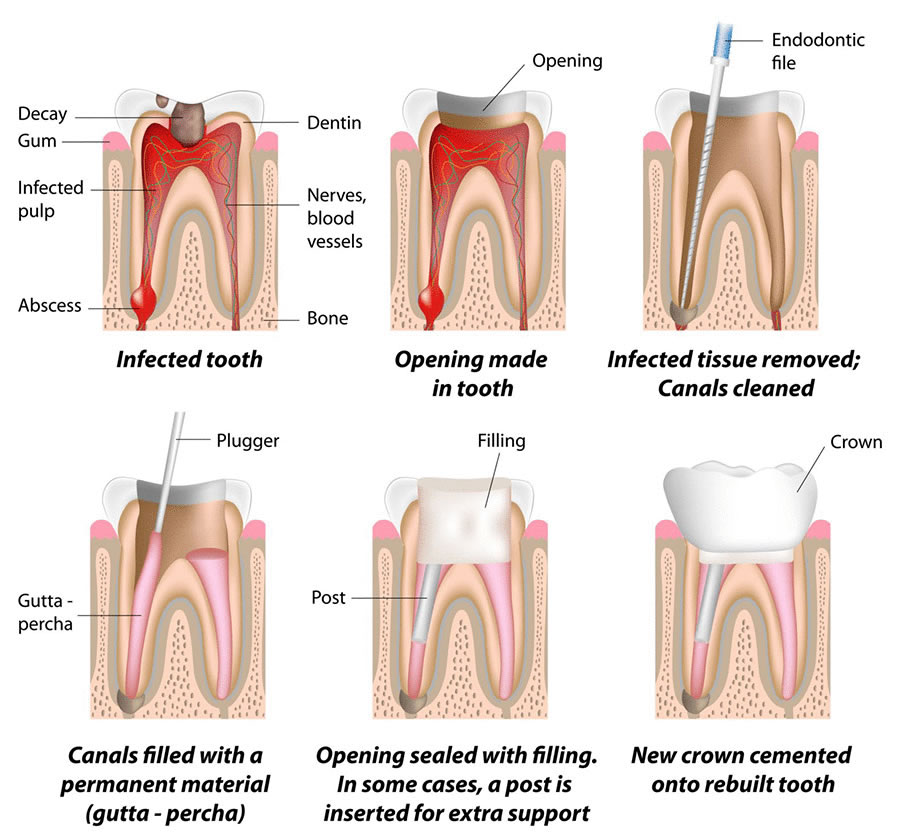 Root canal treatment